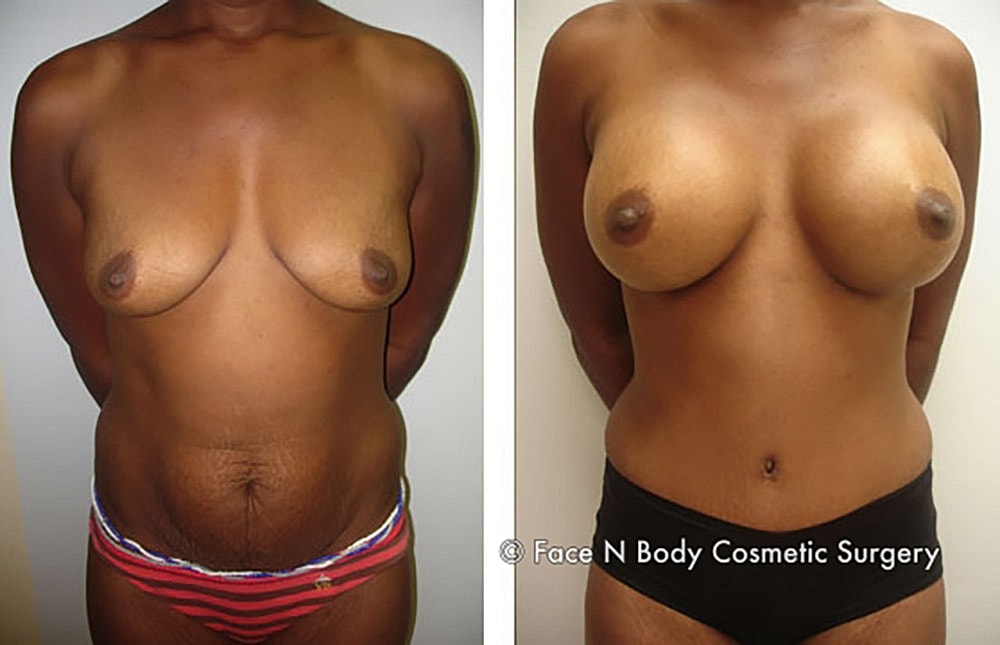 Mommy Makeover Before & After