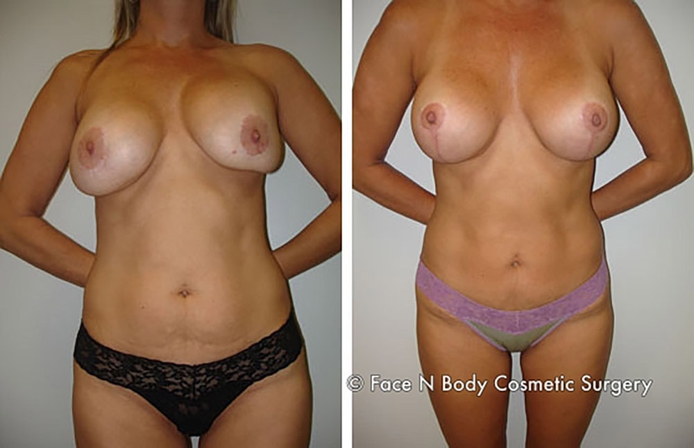 Mommy Makeover Before & After