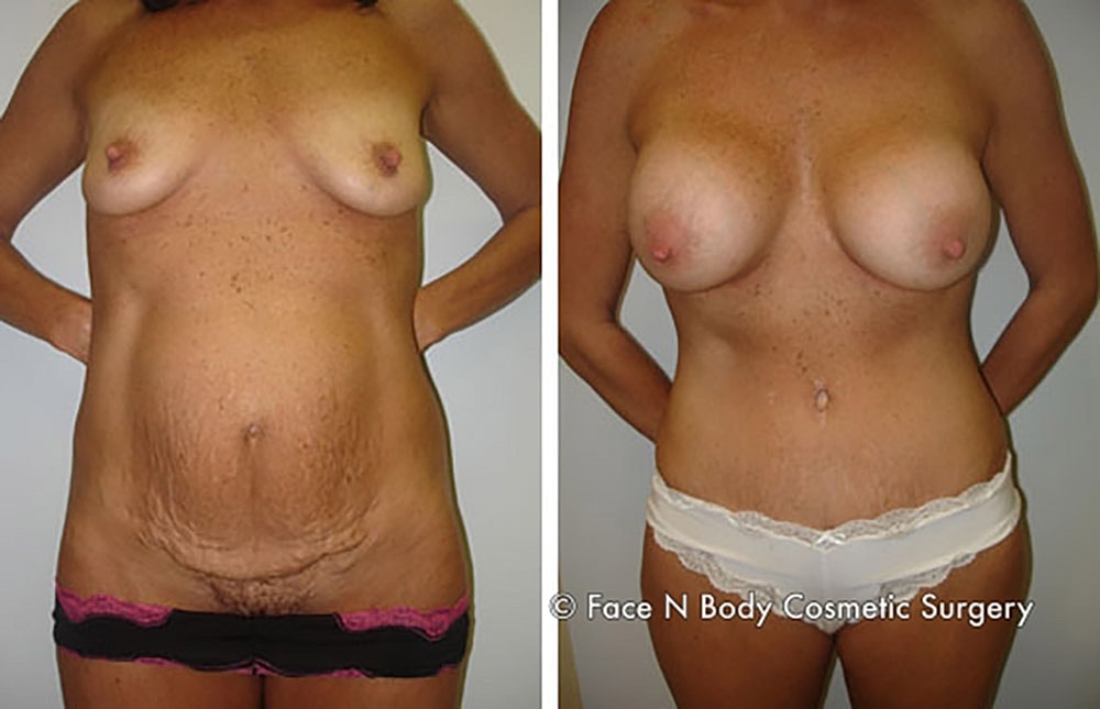 Mommy Makeover Before & After