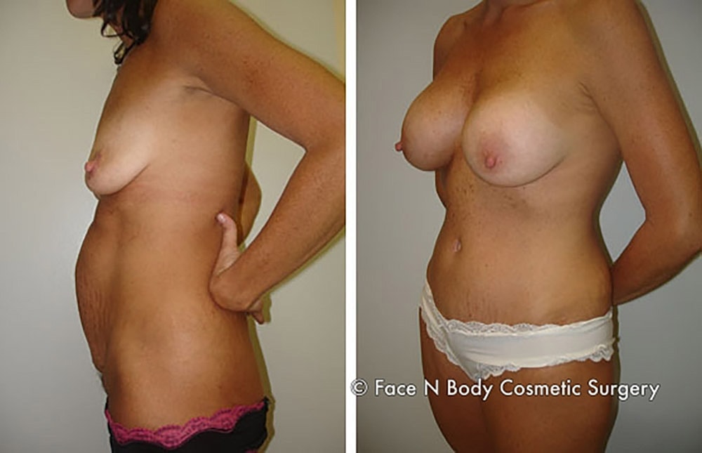 Mommy Makeover Before & After