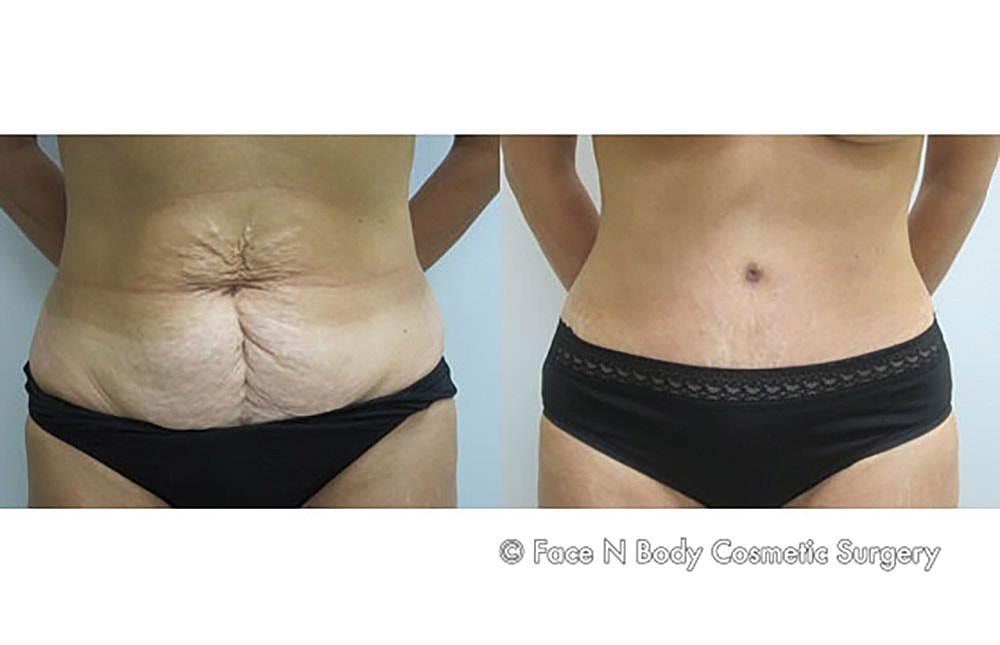 Mommy Makeover Before & After