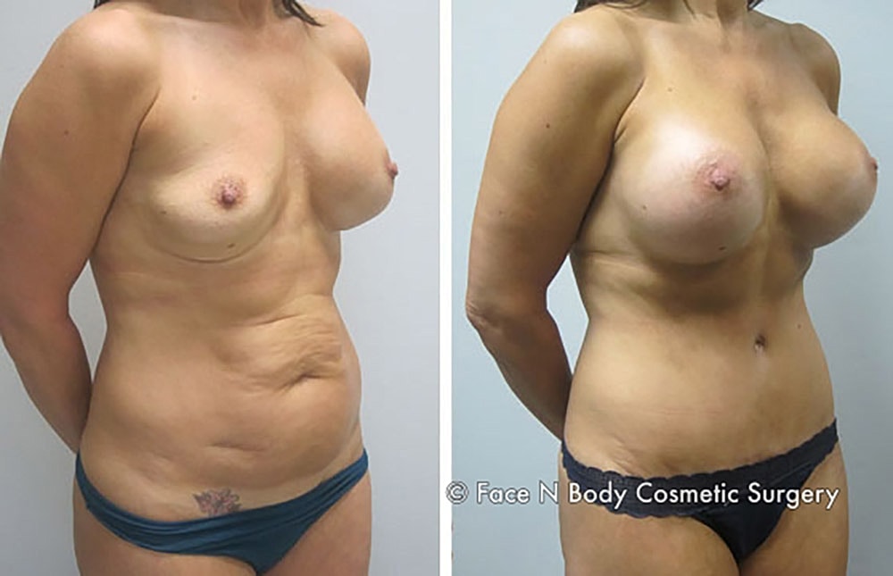 Mommy Makeover Before & After