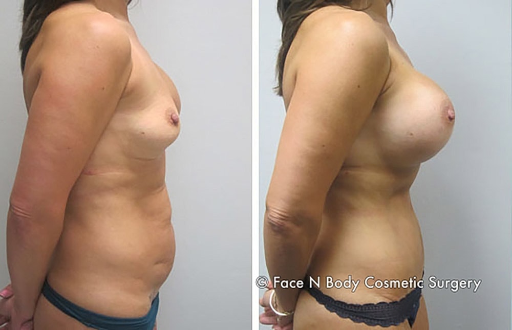 Mommy Makeover Before & After