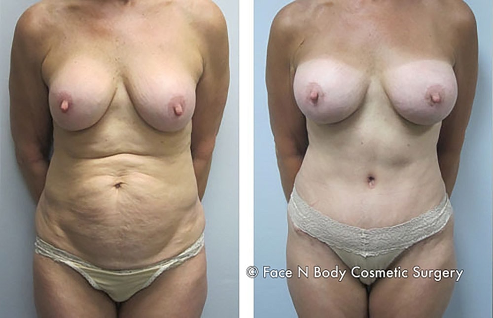 Mommy Makeover Before & After