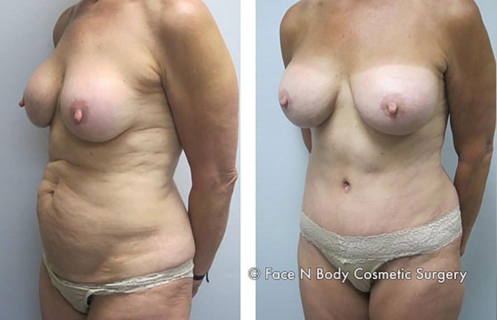 Mommy Makeover Before & After