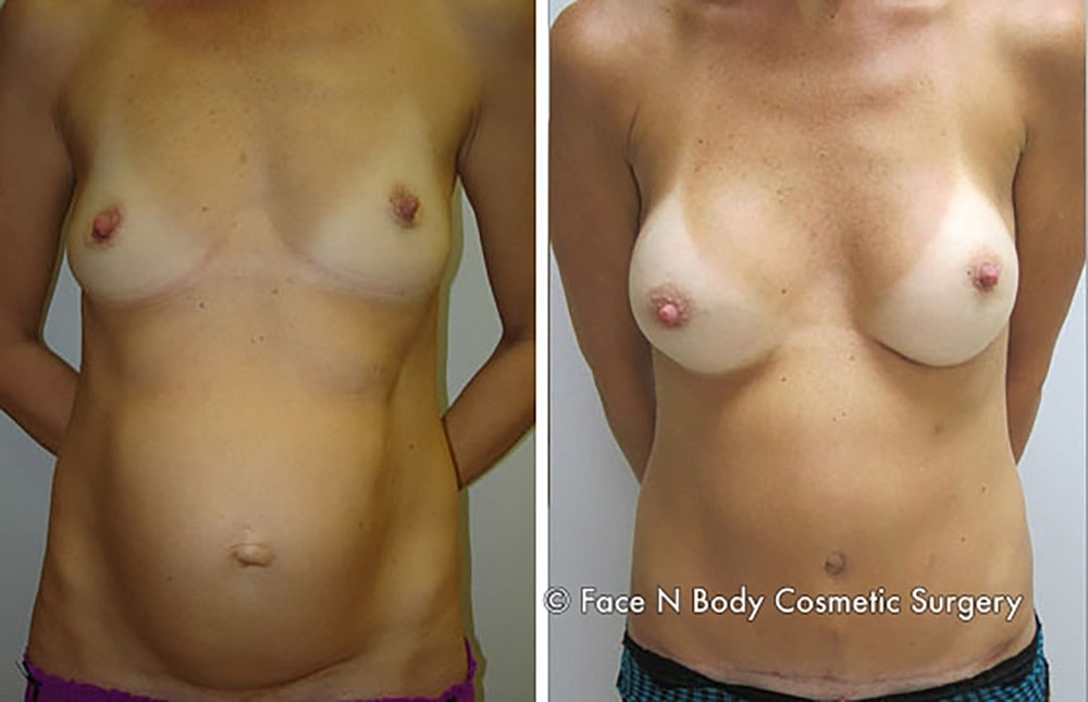 Mommy Makeover Before & After