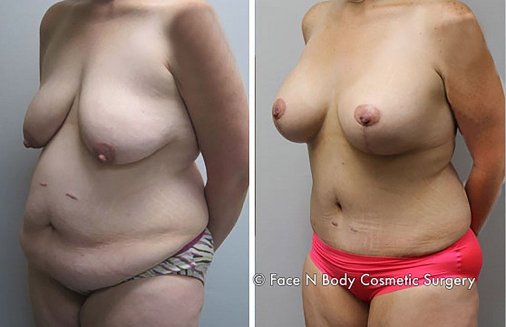 Mommy Makeover Before & After