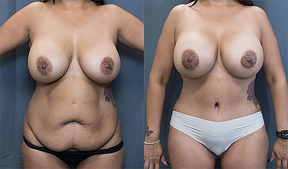 Mommy Makeover Before & After