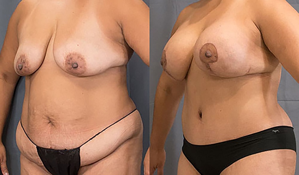 Mommy Makeover Before & After