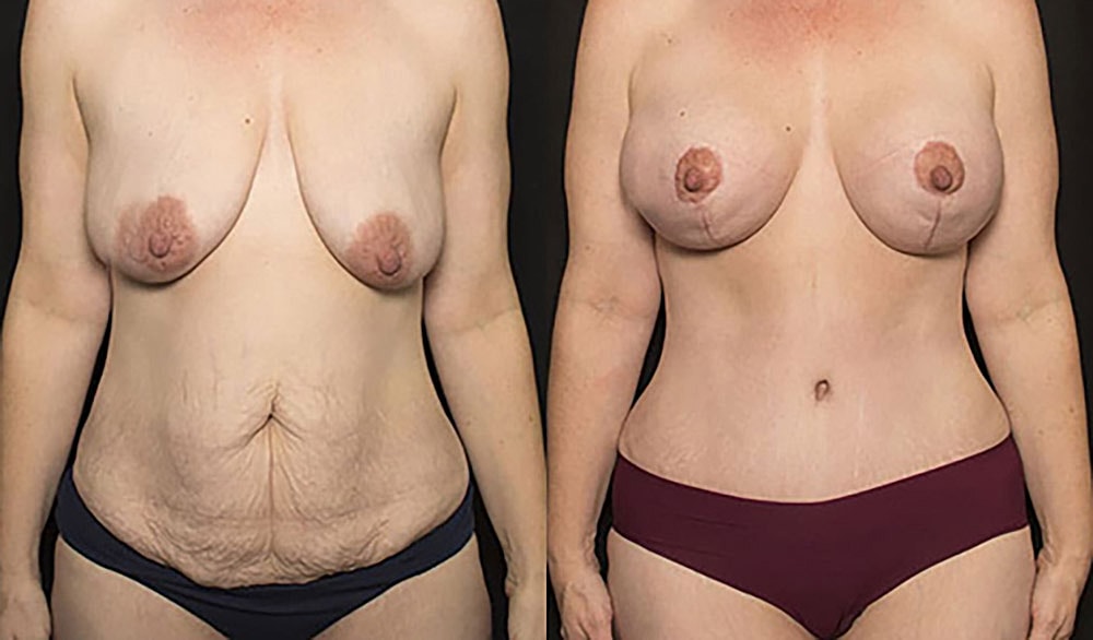 Mommy Makeover Before & After