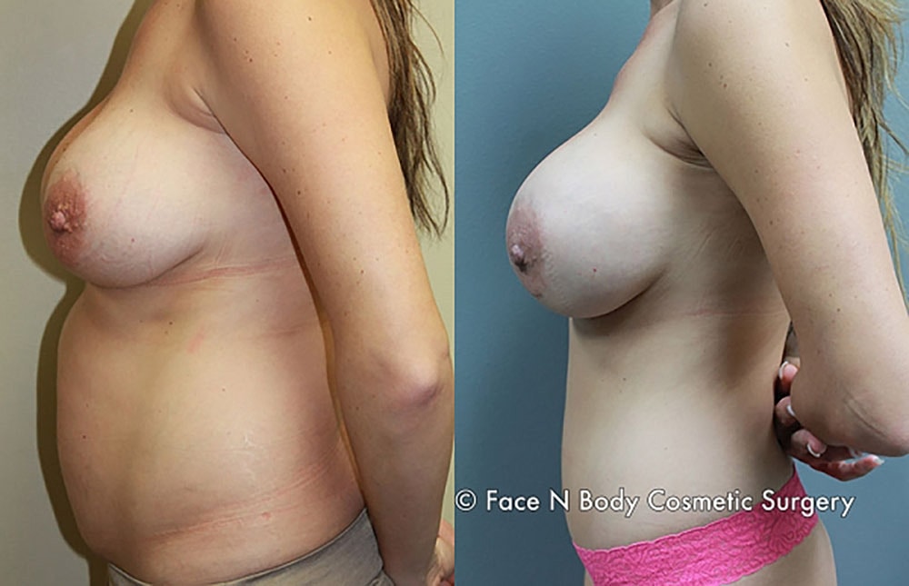 Mommy Makeover Before & After