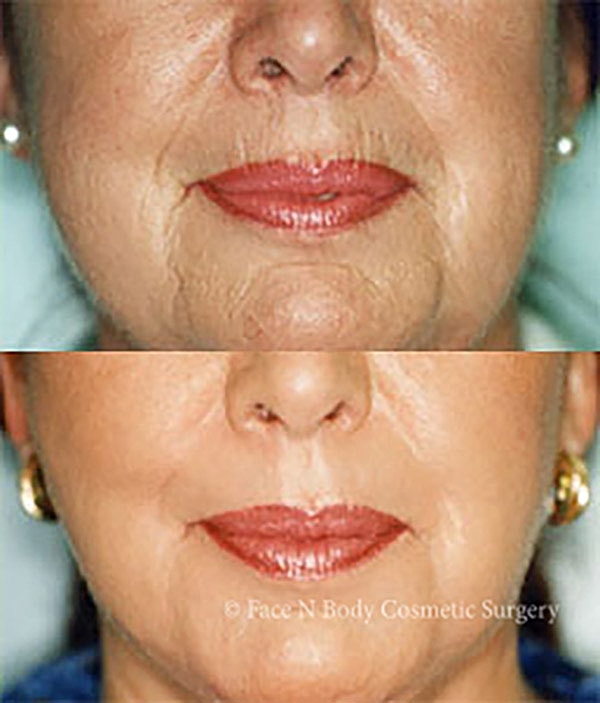 Laser Skin Resurfacing Before & After