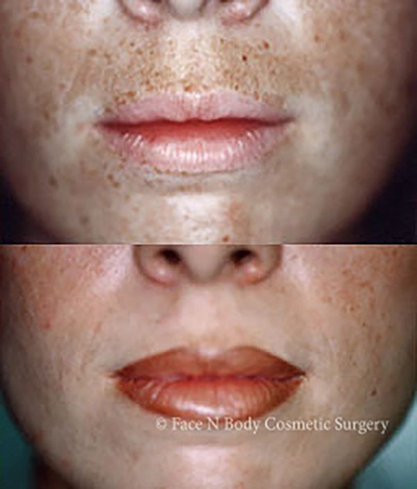 Laser Skin Resurfacing Before & After