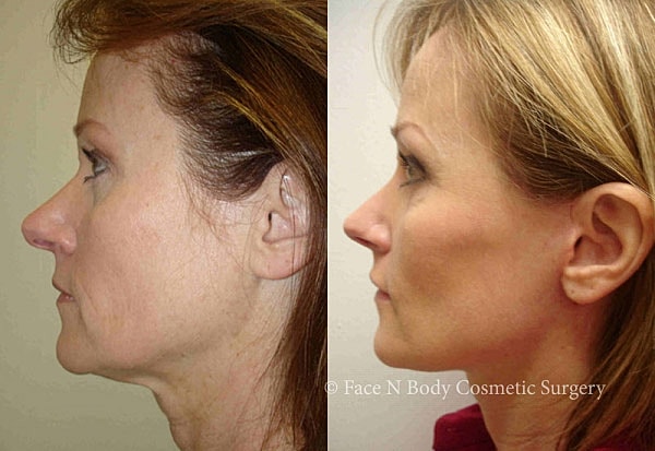Laser Skin Resurfacing Before & After