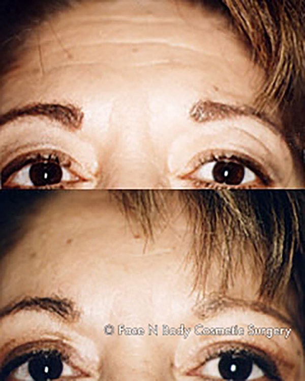 Brow Lift Before & After