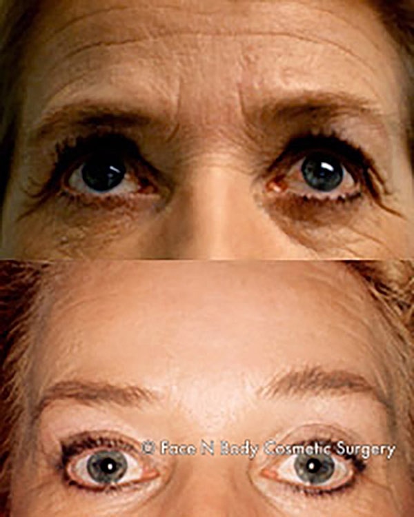 Brow Lift Before & After