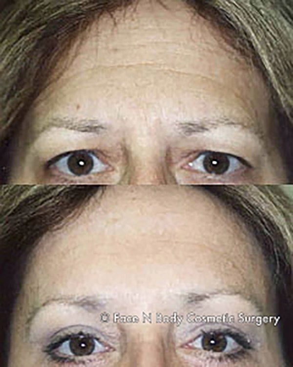 Brow Lift Before & After