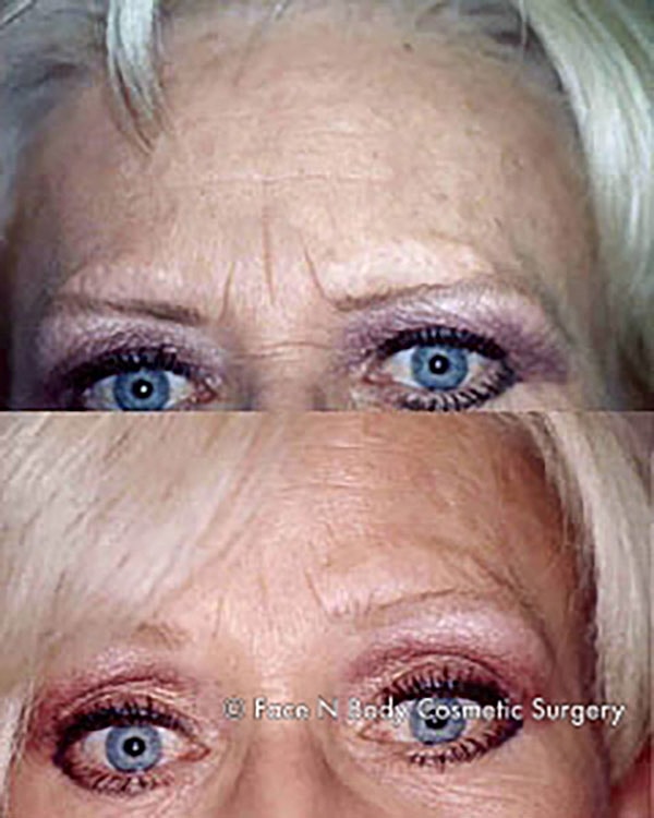 Brow Lift Before & After