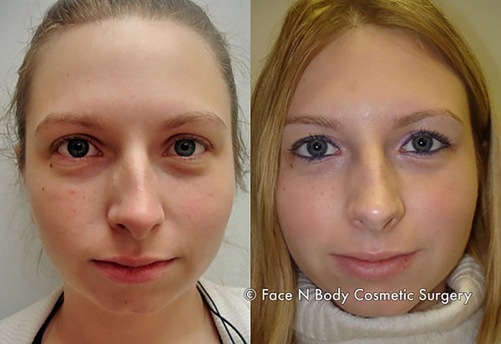 Rhinoplasty Before & After