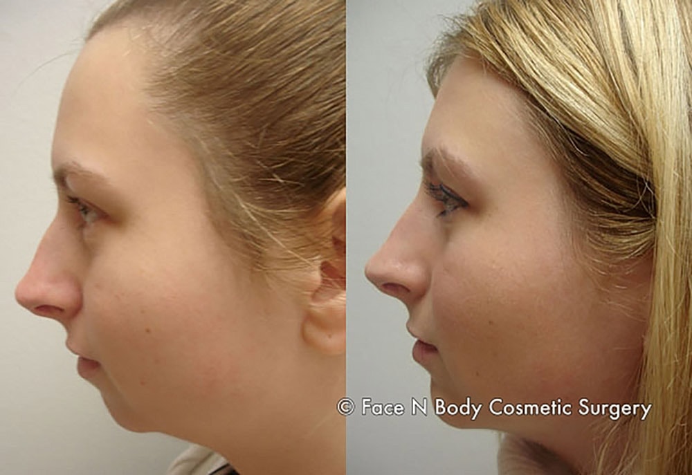 Rhinoplasty Before & After