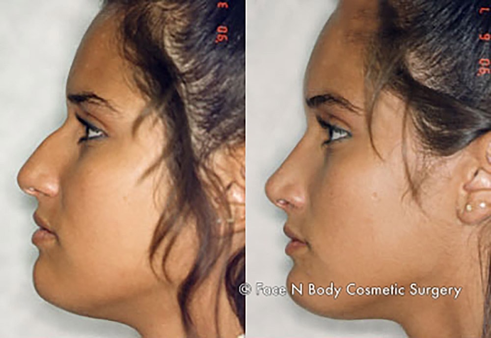 Rhinoplasty Before & After