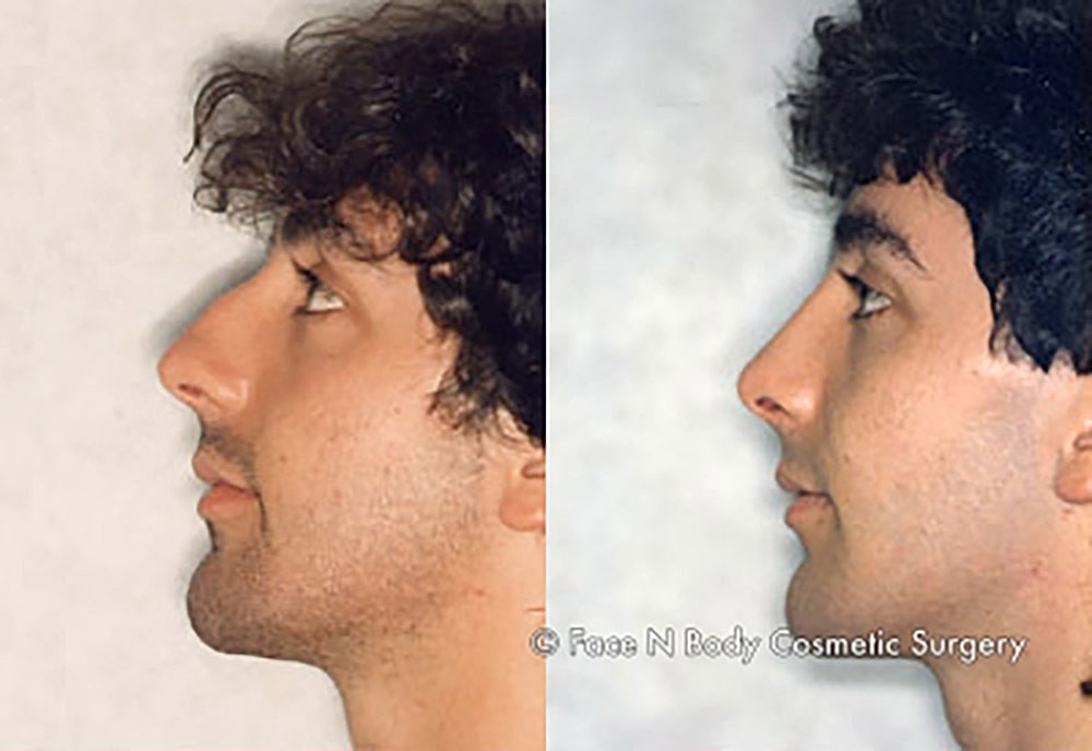 Rhinoplasty Before & After