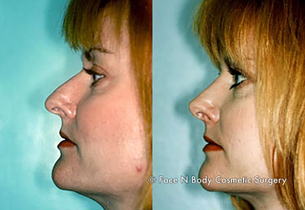 Rhinoplasty Before & After