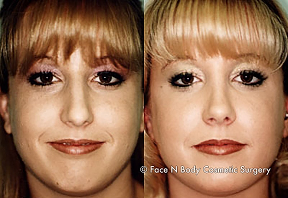 Rhinoplasty Before & After