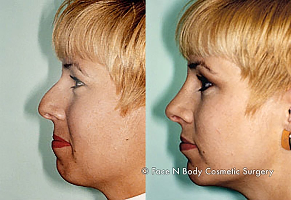 Rhinoplasty Before & After