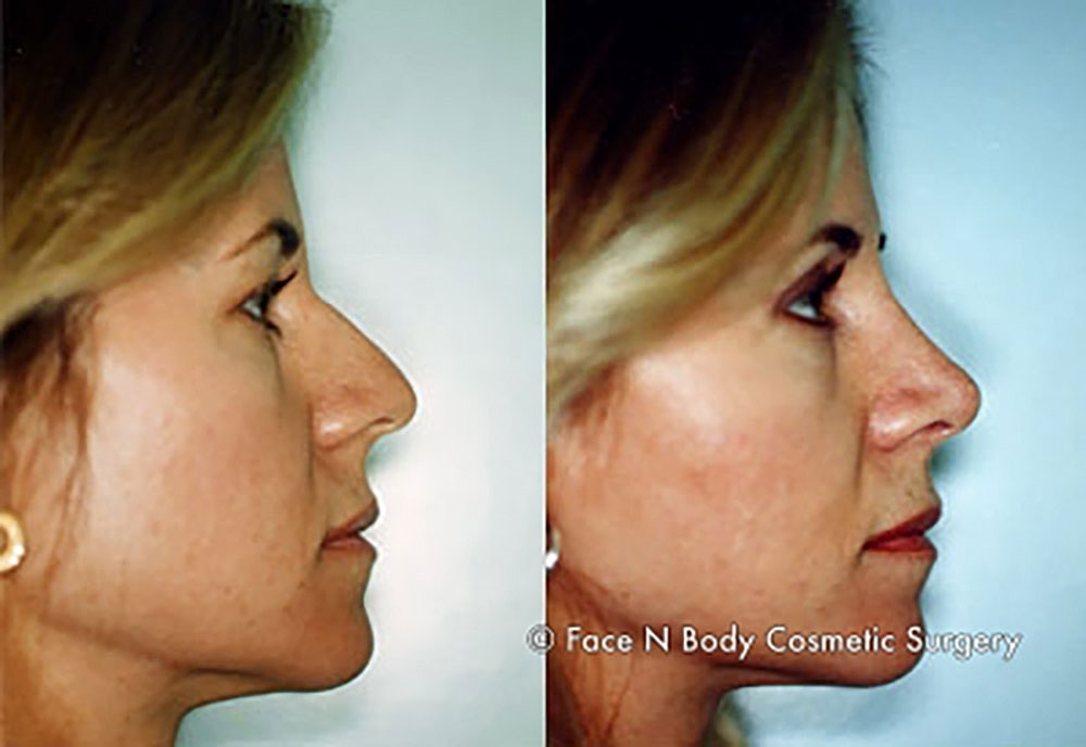 Rhinoplasty Before & After