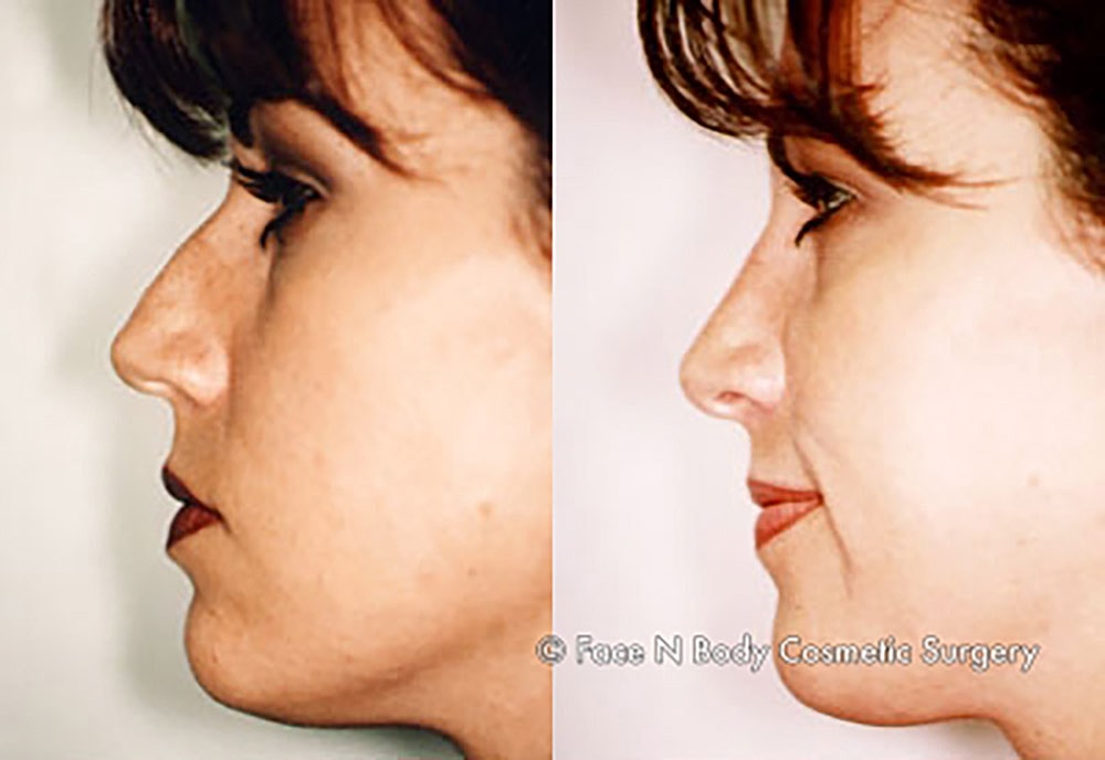Rhinoplasty Before & After