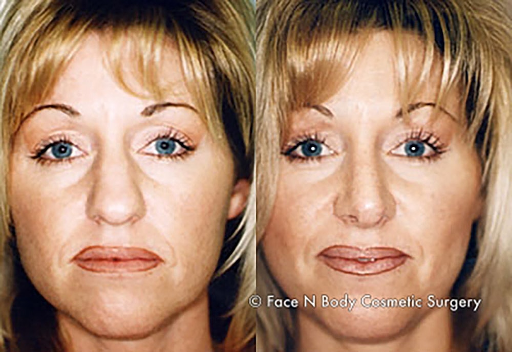 Rhinoplasty Before & After