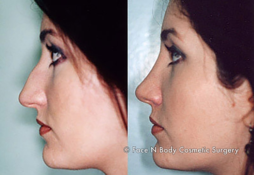 Rhinoplasty Before & After