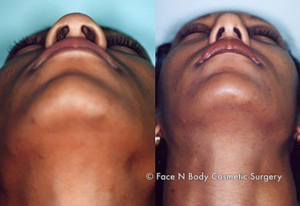 Rhinoplasty Before & After