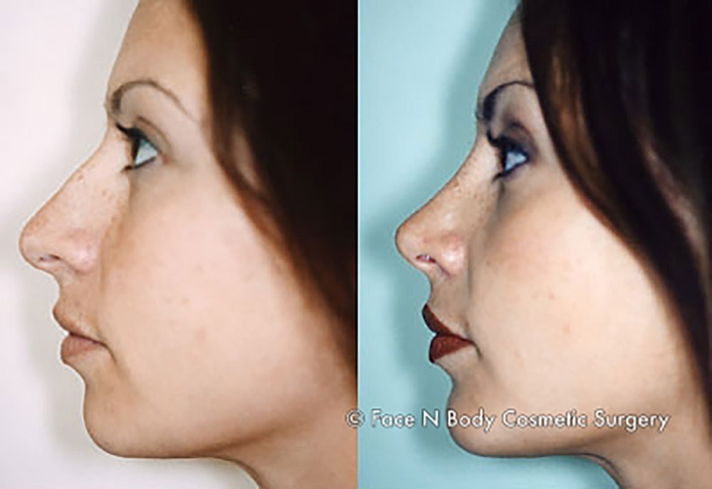 Rhinoplasty Before & After