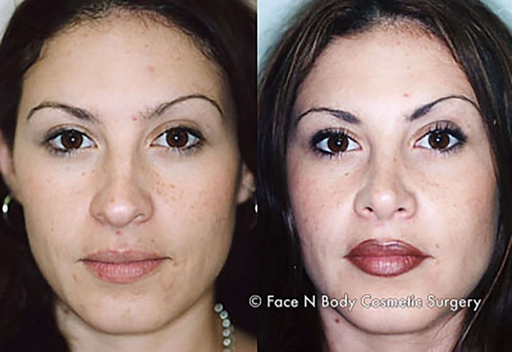 Rhinoplasty Before & After