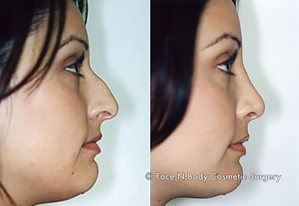 Rhinoplasty Before & After