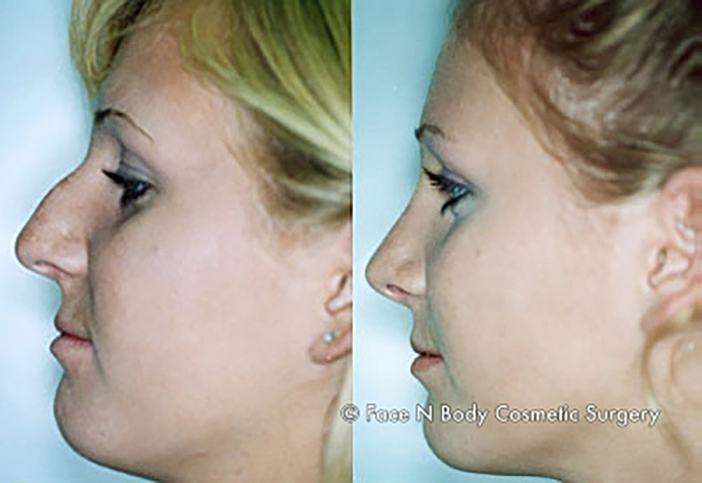 Rhinoplasty Before & After