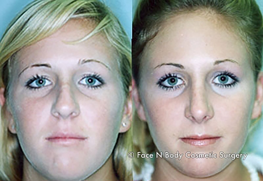 Rhinoplasty Before & After