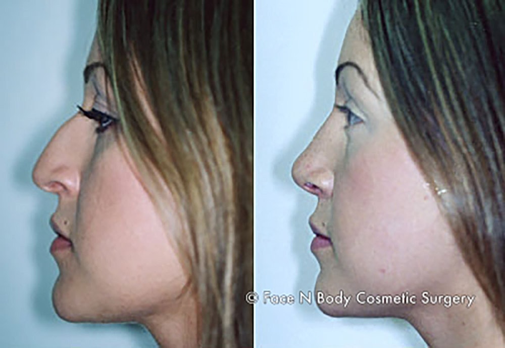 Rhinoplasty Before & After