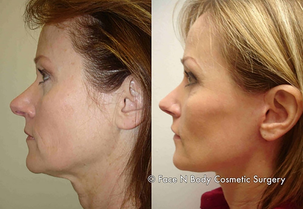 Rhinoplasty Before & After