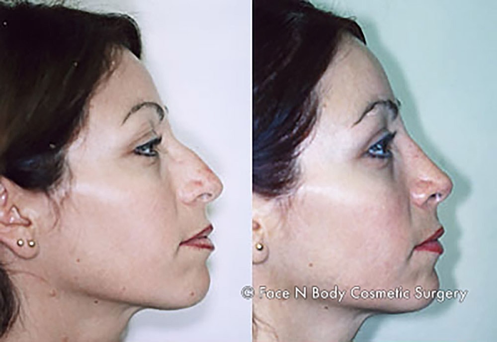 Rhinoplasty Before & After