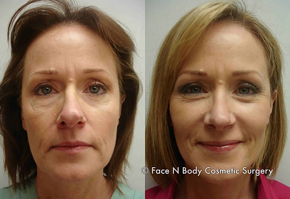 Rhinoplasty Before & After