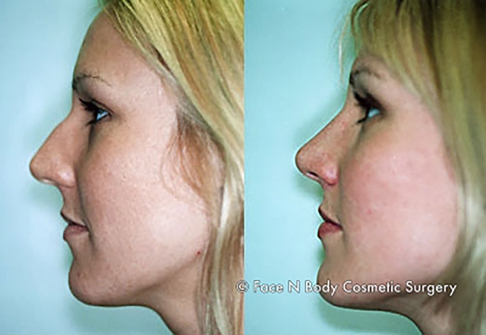 Rhinoplasty Before & After
