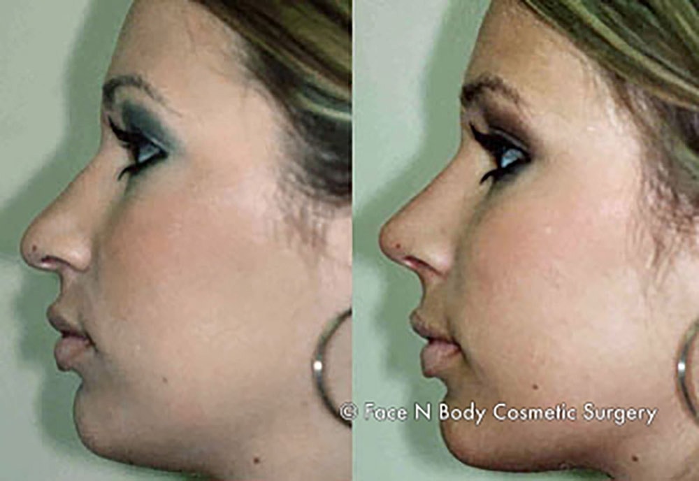 Rhinoplasty Before & After
