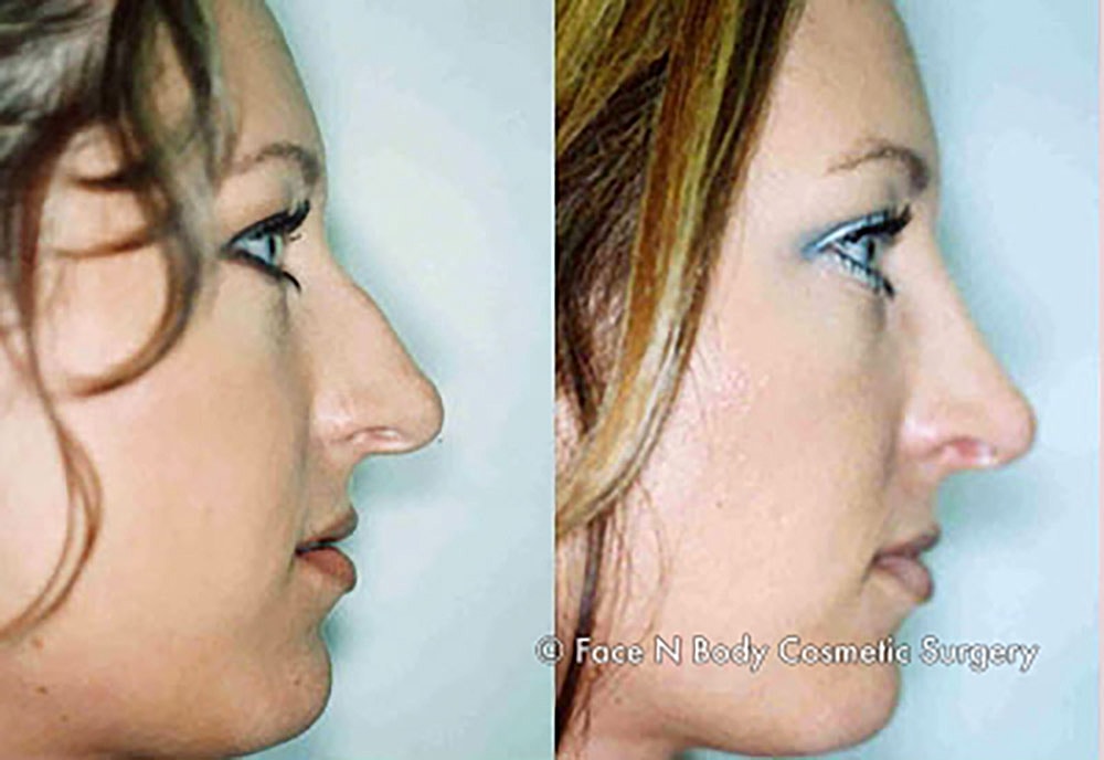 Rhinoplasty Before & After