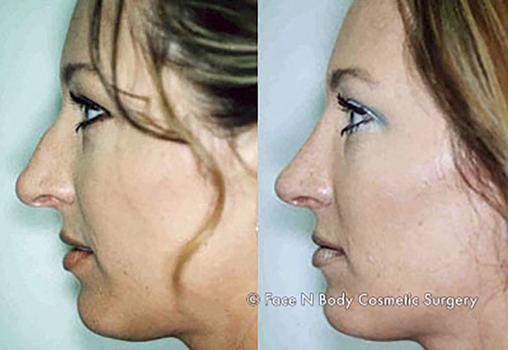 Rhinoplasty Before & After