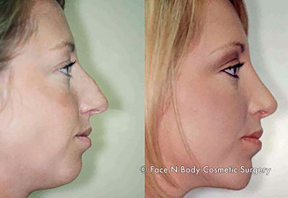 Rhinoplasty Before & After