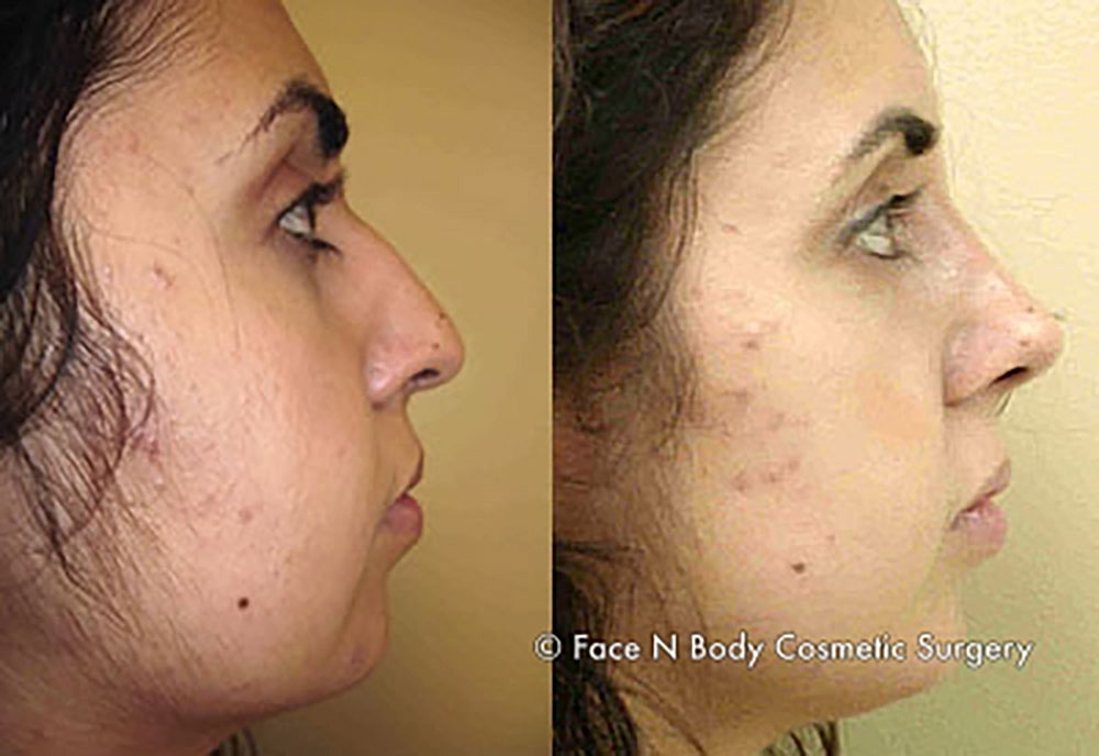 Rhinoplasty Before & After
