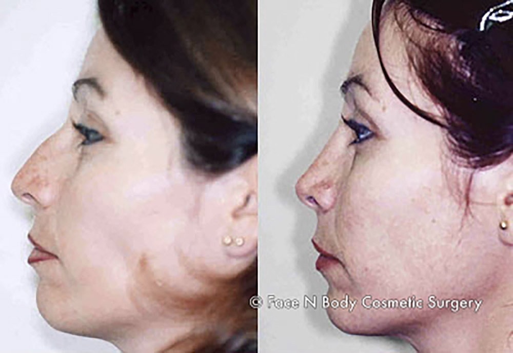 Rhinoplasty Before & After